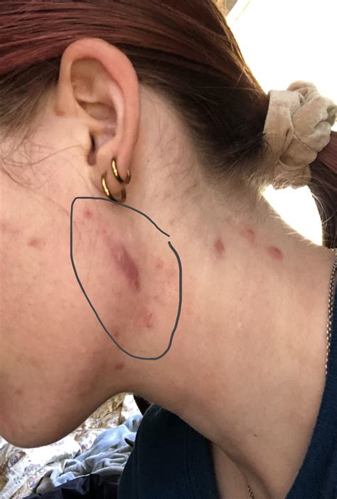 [Skin Concerns] Has anyone ever had a cystic pimple return/refill after a cortisone injection ...