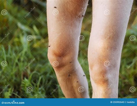 Insect bite on human skin stock image. Image of danger - 255992643