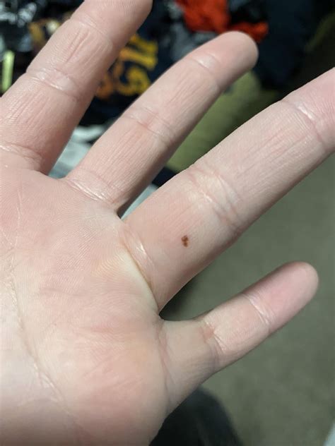 Mole like spots on finger : r/Melanoma