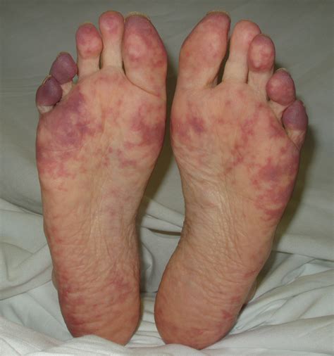 Purple Toes Syndrome