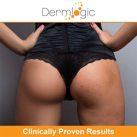 Anti-Acne Thigh & Buttocks Treatment - Clear Pimples & Ingrown Hairs, Prevent Breakouts - 6.09 ...