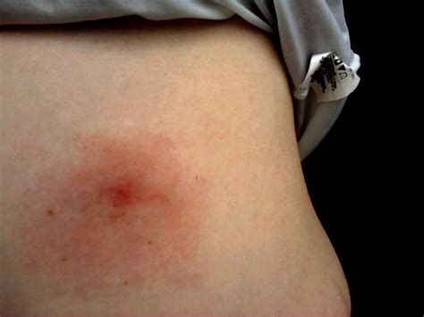 Medical Term Bulls Eye Rash at Dorathy Quinones blog