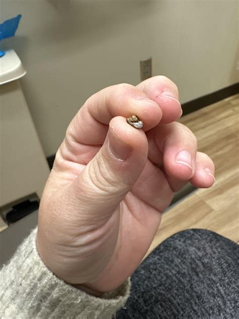 7mm kidney stone hell : r/KidneyStones