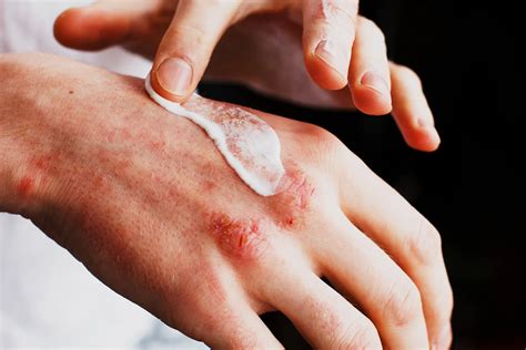 Eczema Treatments and Remedies | LifeMD