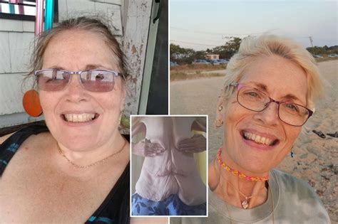 Weight loss left me with 20 lbs of excess skin — I prefer being heavier