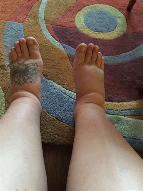 Postpartum edema — is this normal!?! More in comments. : r/BabyBumps