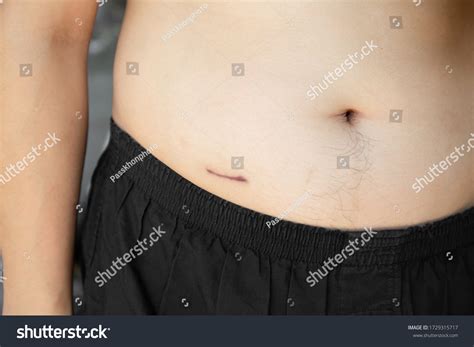Closeup Man Showing Stomach Scar Appendicitis Stock Photo 1729315717 | Shutterstock