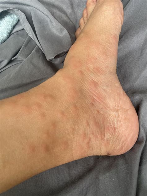 Sand Fleas bites in Puerto Rico - Work Travel and Take photos