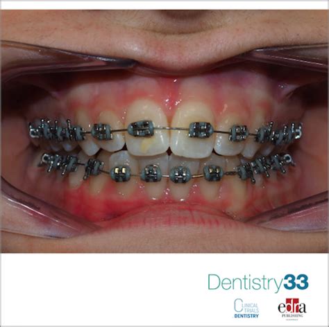 Mbt Orthodontic Bracket Prescription at Mary Spaulding blog