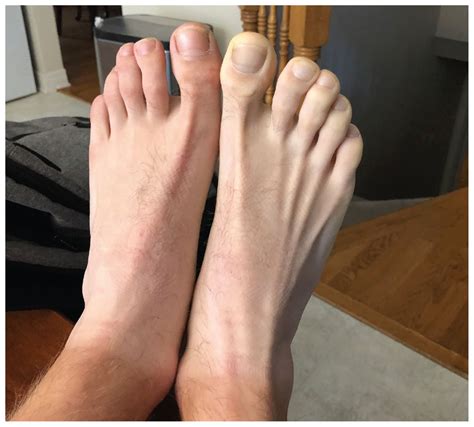 Popliteal artery entrapment syndrome in a 20-year-old man | CMAJ