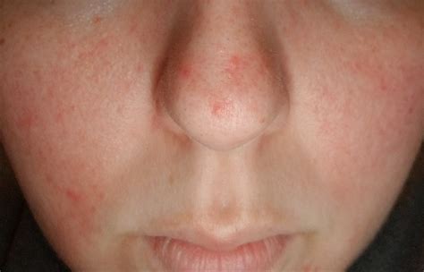 [Skin Concerns] Red bumps on nose and cheeks : SkincareAddiction