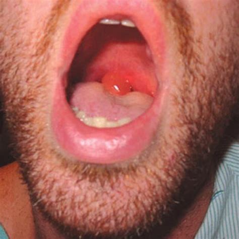 Uvula Cancer
