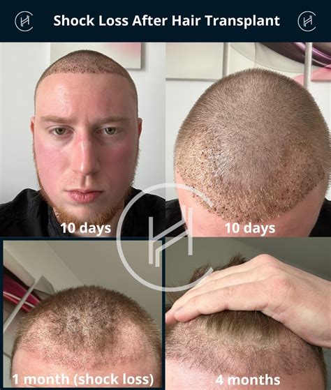 Loss Before And After Hair Transplant Hair Transplant Results: What