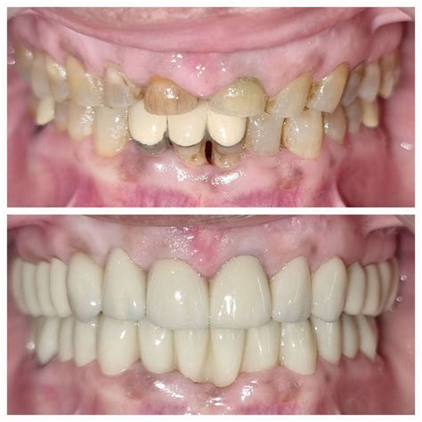 Treatment of Severely Attrited worn Teeth - Full Mouth Zirconia Crowns ...