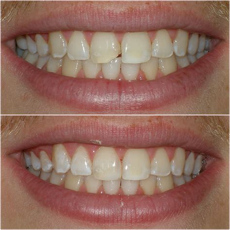 How To Fix A Chipped Front Tooth - HSNODK