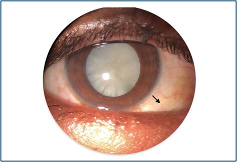 Descolamento tracional de retina bilateral em hemoglobinopatia S-C ...