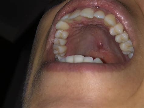 Bump on the roof of my mouth: I randomly got this bump, it hurts.Does anyone’s know what it may ...