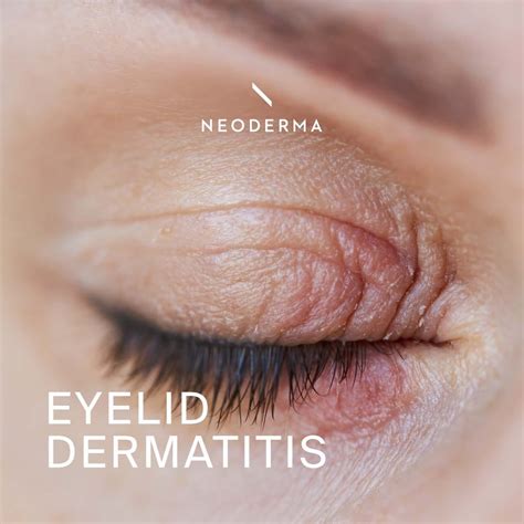 Eczema Honey On Eyelids at Milla Gadsdon blog