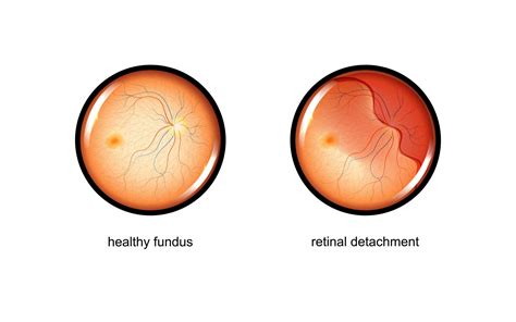 Retinal Tear Causes, Symptoms & Treatments