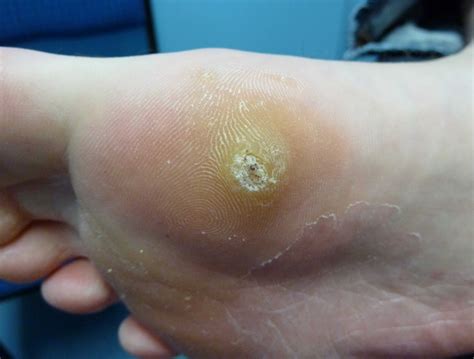 How Do Foot Doctors Remove Plantar Warts at Regena Rudolph blog