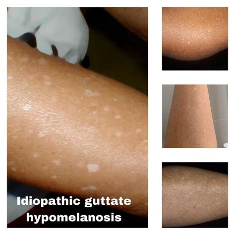 Idiopathic Guttate Hypomelanosis