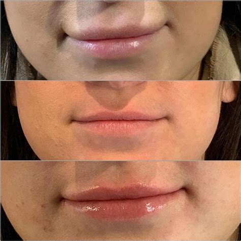 Is Getting My Lip Filler Dissolved Dangerous? | Glowday