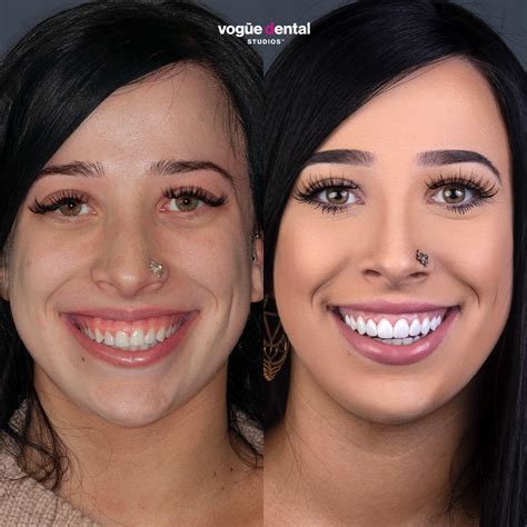 Gummy Smile Surgery