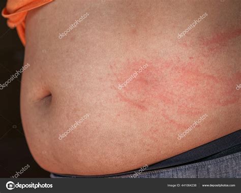 Itchy Skin That Causes Welts at Leticia Martinez blog