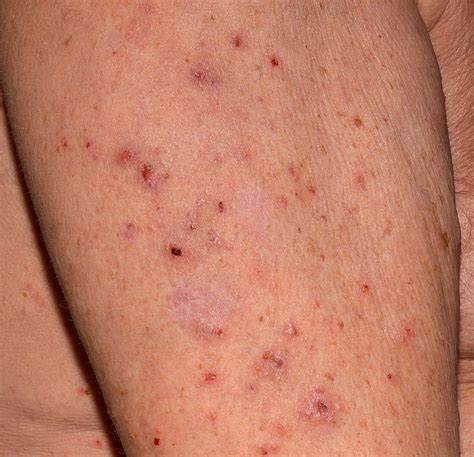 Image Of Crusted Scabies