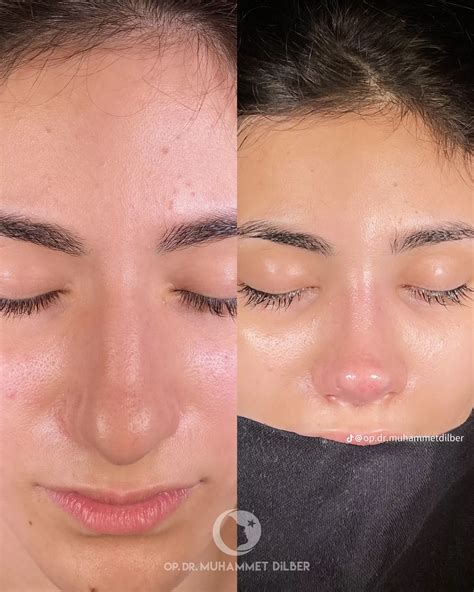 Pin by Lynn Schmid on Nasenop wunsch in 2025 | Nose job, Nose job recovery, Rhinoplasty nose jobs