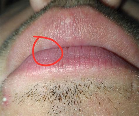 White Bumps On Lips