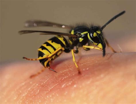 Wasp, yellow jacket & bee sting, symptoms, diagnosis & treatment