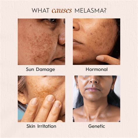 Melasma - Dark Patches on Your Skin – Suganda Skincare