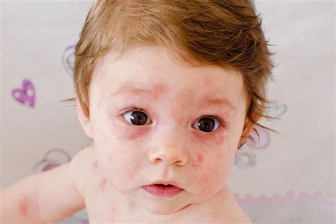 Viral Rash Toddler