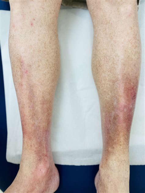 Venous Stasis (Stasis Dermatitis): Symptoms & Treatment