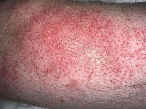 HELP does my husband need to go to ER (concrete burn) : r/Concrete