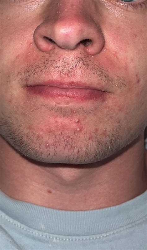 could this be gram negative folliculitis? should i test for it? : r ...