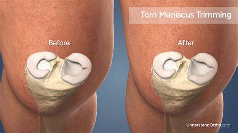 Torn Meniscus Trimming – UnderstandOrtho™