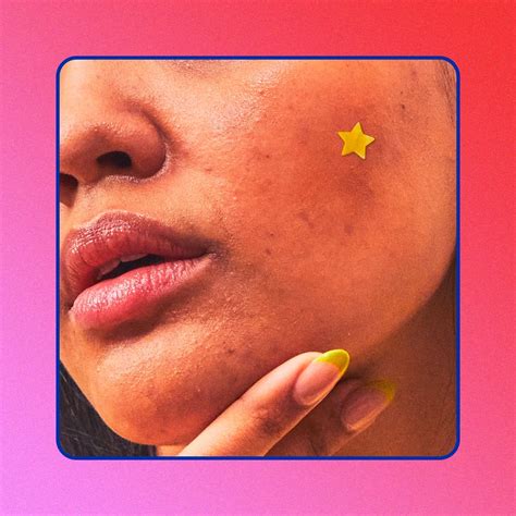 How to Get Rid of Pimples Under the Skin | POPSUGAR Beauty