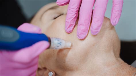 Acne Scars Treatment | Crown Med Spa | Crown Point