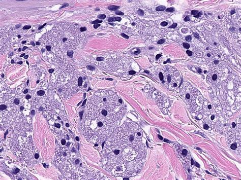 Pathology Outlines - Granular cell tumor