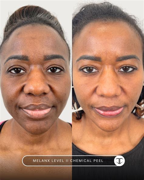 CO2 Laser Level 1 vs. Level 2: How It Works and What to Expect | Charette Cosmetics