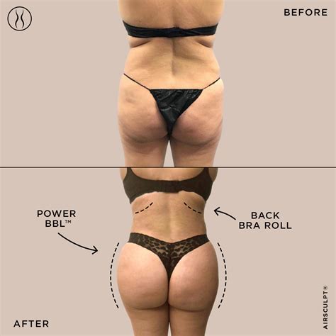 Buttock Lift : How It’S Done, Risks – PCETSK