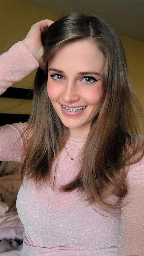 Braces And Smile Lines at James Vines blog