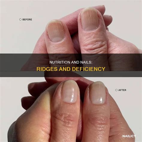 Nutrition And Nails: Ridges And Deficiency | Nailicy