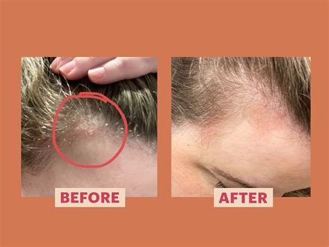 Psoriasis Scalp