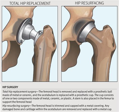 Hip Resurfacing Surgery