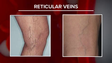 Treatable leg vein conditions often go undiagnosed | wwltv.com