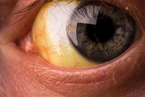 Scleral Icterus: Causes, Symptoms & Treatment