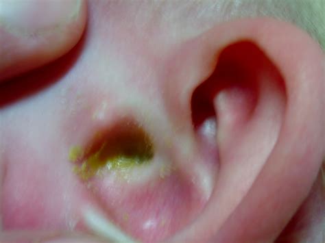Infected Ear Drum